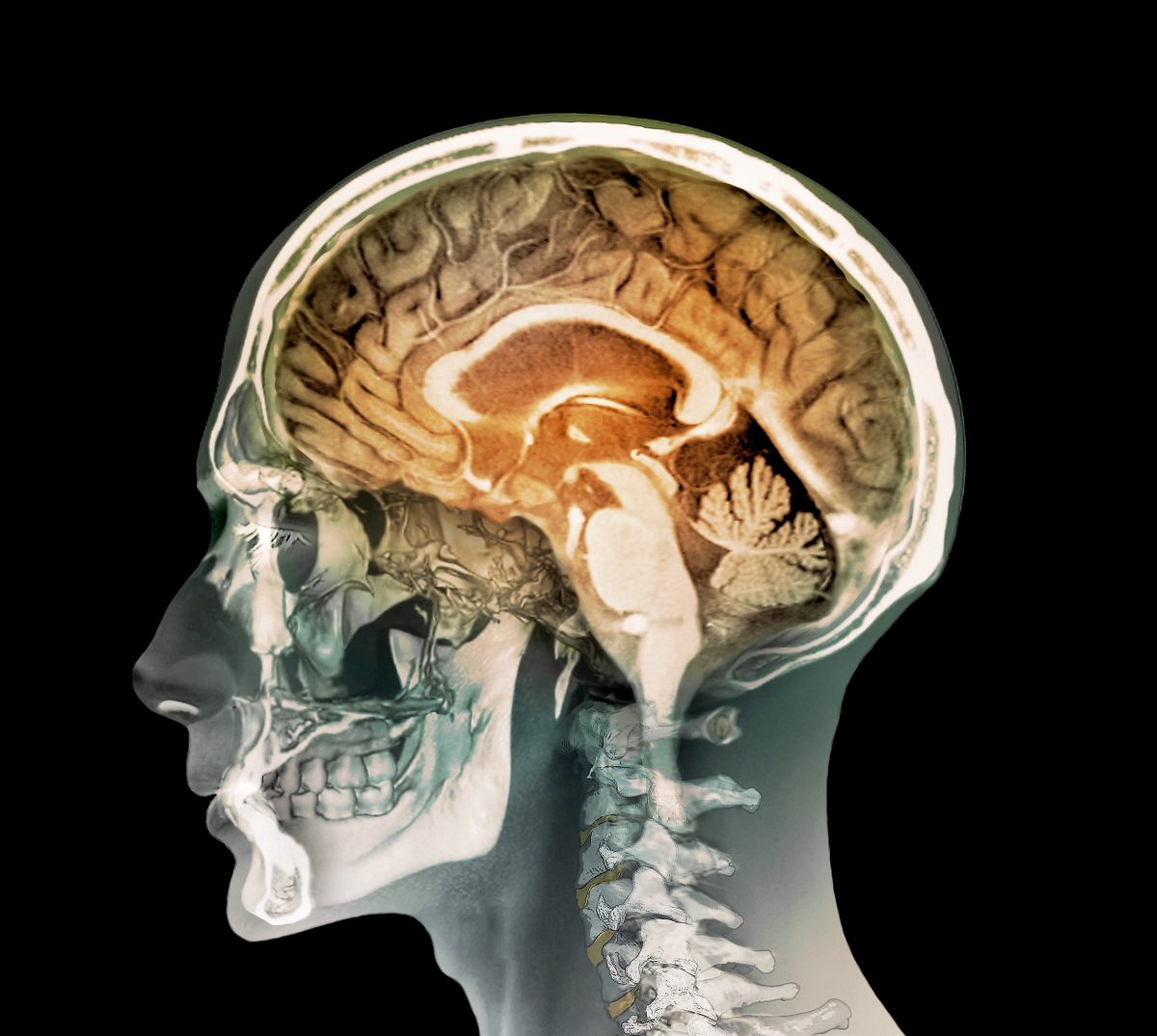 Human head. Coloured composite image of a magnetic resonance imaging (MRI) scan of the brain and 2D and 3D computed tomography (CT) scans of the head and neck of a 35 year old patient. The highly folded area of the brain is the cerebrum, which is responsible for conscious thought, emotion and voluntary movement. The orange arch beneath it is the corpus callosum, which facilitates communication between the hemispheres. At bottom right is the cerebellum, which controls muscle coordination and balance